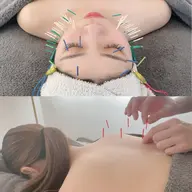 💎ミニモ限定💎美容鍼＋BODY鍼灸セット→33％OFF😳💖このメニューならお顔もお身体もスッキリ💭✨
