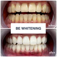 【🚨短期集中ホワイトニング🚨】ホワイトニング3週間通い放題￥33,000(1日15分照射×2回)安心の最低保証付⭐️