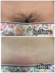 【はじめての方多数🍋】VIOシュガーリング｜やさしい脱毛｜モニター