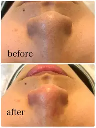 毛穴洗浄スチーマー付き🩵