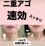 EMS若見えフェイシャル