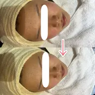 【ツルんっ‼︎と卵肌】徹底毛穴洗浄🎵+角質除去効果のあるモデリングパック