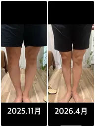 骨盤矯正、O脚矯正