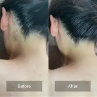 美肌脱毛Ｌパーツ　　ヒジ上、ヒジ下、ヒザ上、ヒザ下、背中上、背中下、おなか、胸、おしり、うなじの1箇所