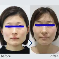 👑全国人気NO.1！👑【小顔矯正+美顔マッサージ】+【首肩矯正】💆 50分＜小顔美顔/エラ張り/首を長く細くなど＞