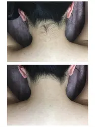 【うなじ】🔰脱毛モニター募集中🔰3回3,900円💙Primaの人気部位💙イベント前にも☺️