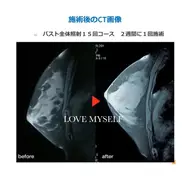 光バスト(フォト)美背中マッサージ＋お胸