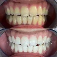 【初めての方専用💎】セルフホワイトニング体験✨️超🉐1,500円🦷✨15分照射で白さ実感🔥