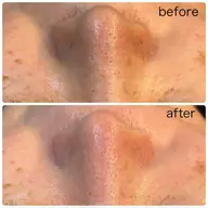 【黒ずみ・詰まり毛穴に】毛穴吸引+ハーブピーリング🌿本気の毛穴ケア✨ 剥離なし、ダウンタイムなし、敏感肌◎