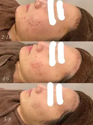 【ﾘﾋﾟｰﾀｰ様限定】ﾊｰﾌﾞﾋﾟｰﾘﾝｸﾞ🌿（剥離あり）＋美容液＋保湿＋鎮静ﾊﾟｯｸ