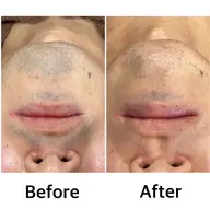 【新規男性/人気NO.1/短期間でカミソリいらず】ひげ光脱毛体験¥2200