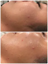 【繰り返す肌荒れに】REVIハーブピーリングで肌環境を整えるケア