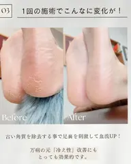 ふわふわかかと角質ケア
