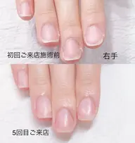 《ハンド短期集中深爪矯正アクリル使用》施術合計4回(ご来店目安3週に1回)オフ込