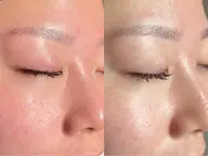 フルフェイスWAX顔脱毛×フルフェイス毛穴洗浄