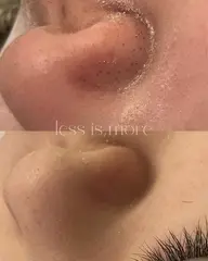 毛穴【毛穴ケア】金の糸顔脱毛✨産毛ケア＋毛穴引き締め