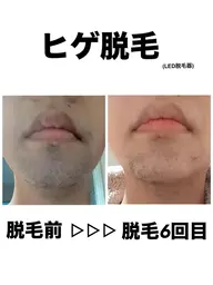 【毎朝のヒゲ剃り卒業✨時短&清潔感UP😎🔥】 ヒゲ脱毛 通常6,000円→3,980円