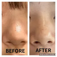 小鼻の黒ずみ超音波徹底洗浄‼︎