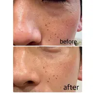 メンズフェイシャルコース✨天然ミネラルベースの角質ケアでさっぱりツルツルの仕上がりに^_^