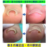 巻き爪ケア　2爪(google口コミ投稿特別価格)