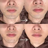 【まずはお試し🆗】men's美肌ヒゲ脱毛(顎/鼻下/頬/首/もみあげ)