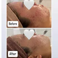 【トレンド美容✨】エクソームピーリング💎