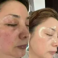 💝スピダイヤで水光肌へ肌質改善💝60分　塗るポテンツアーで整形級に変身！韓国女優のようなキュッと引き締まった水光肌へ