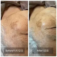 ☆プラズマ美容フェイシャル