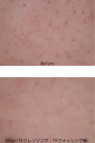 毛穴ケアモニター