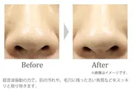 【毛穴ディープクレンジング(パック付)】ニキビ・いちご鼻🍓・お化粧崩れ、お化粧のりにお悩みの方に❣️✨️