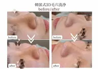 【一度で別人級】毛穴洗浄×BBL光フェイシャル✨透明感・ハリ同時仕上げ