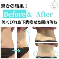 【お腹のぜい肉撃退☆-3cm美くびれ】LD×キャビ×ラジオ波×バキューム×EMS