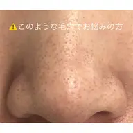 得！！角栓毛穴ケアニキビケア若々しい肌にソフトピーリングのハイドロスキン集中3回コース