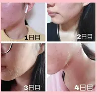 平日限定‼️フェイスハーブピーリングノーマル(剥離あり)🌿ニキビ、ニキビ跡、毛穴、肌質改善🩷土、日、祝日は8000円