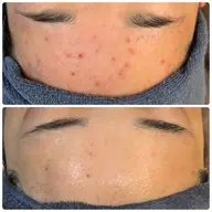 【ニキビ・ニキビ跡に！】次世代ハーブピーリングで本気の肌改善✨すっぴんでも自信の持てるお肌へ♡剥離なし、ダウンタイムなし