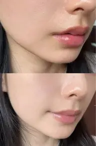 顔脱毛&DPLを同時にご施術/濃さに合わせて40分