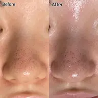 【毛穴撲滅◎】ヒト幹配合〇ごっそり毛穴洗浄　¥9900→8800