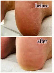 フットケア【爪の形を整え、足裏と爪周りの角質を除去し、マッサージをしてクリームでパックします】