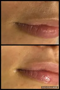 【顔のごわつき・顔の産毛処理・乾燥肌改善】シルク糸顔脱毛エステ✨