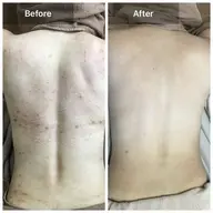 🌿背中ハーブピーリング✨【剥離なし】【毛穴洗浄】【GF美容液】剥離ありに変更→12000円ニキビ/ニキビ跡/毛孔性苔癬