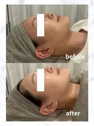 ⭐︎美白メニュー【乾燥やくすみが気になる方へ】最新の韓国プラピールで驚く程の美白ツヤ肌！16,000円→12800円