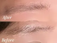 ハリウッドブロウリフト