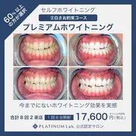 【本気で白くしたい方】プレミアムセルフホワイトニング40分×2来店 合計80分🦷✨
