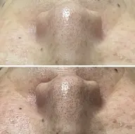 【毛穴の開き、引き締め提案】憧れノーファンデ肌