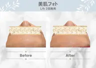 ✨美肌フォト✨おでこ💎