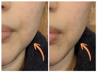 【透明感UP】超音波つるすべ肌フェイシャル✨