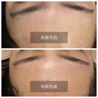 おでこ糸脱毛　糸一本のみ