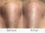 【毛穴改善】剥離ハーブピーリング＆顔リンパマッサージ¥22000→