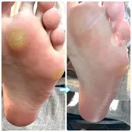 つるつる足裏美人！ドイツ式角質ケア