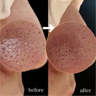 当店オリジナル毛穴ケア【2種類の機械×ハンド技術で毛穴黒ずみ撃退】ピーリング付（70分）￥2,000引